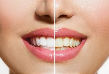 picture comparing teeth before and after whitening
