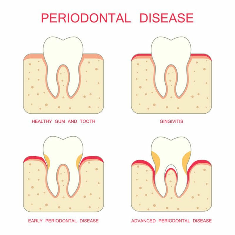 periodontal desease in steps